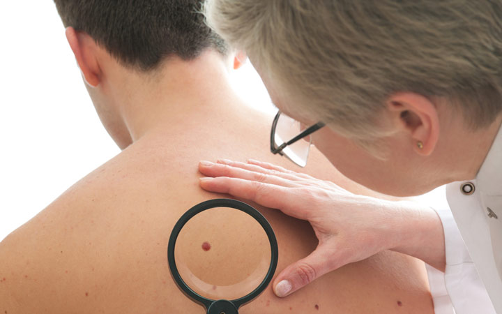 تغییرات پوستی یکی از نشانه های سرطان در آقایان
